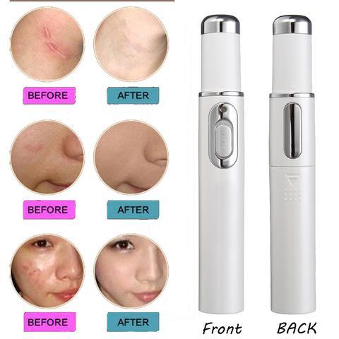 Blue Light Therapy Acne Laser Pen-4